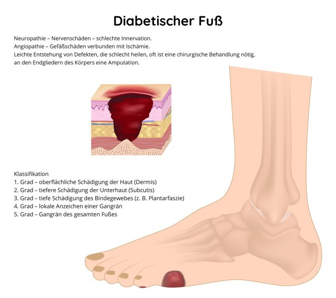 Diabetischer Fuß