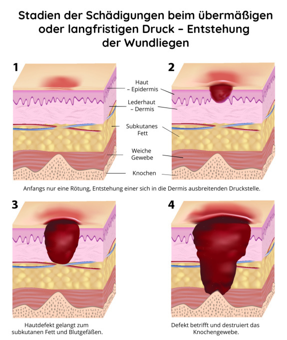 Stadien der Druckschädigung – Entstehung der Wundliegen