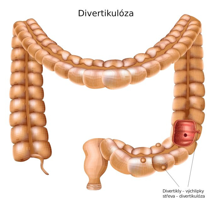 Divertikulose