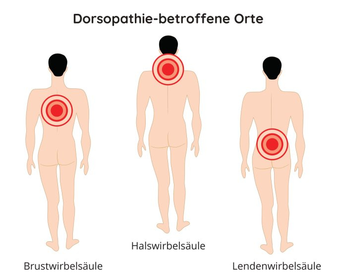 Am häufigsten betroffene Bereiche von Wirbelsäule
