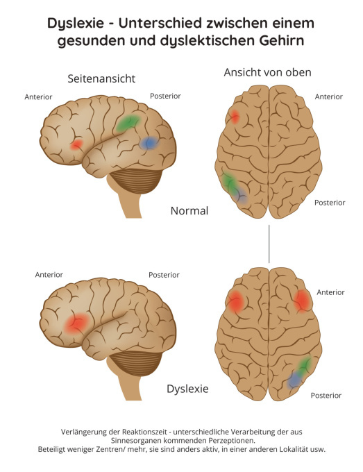 Schematische Darstellung eines von Dyslexie betroffenen Gehirns