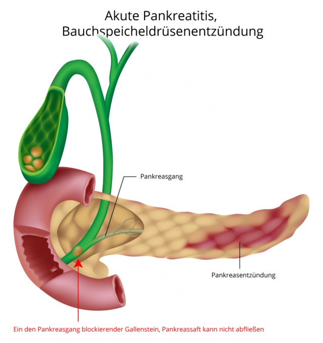 Akute Pankreatitis - Entzündung der Bauchspeicheldrüse