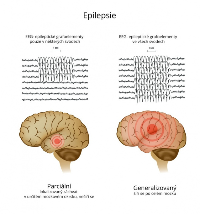 Epilepsie - partieller und generalisierter Anfall