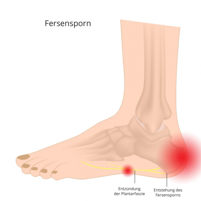 Fersensporn