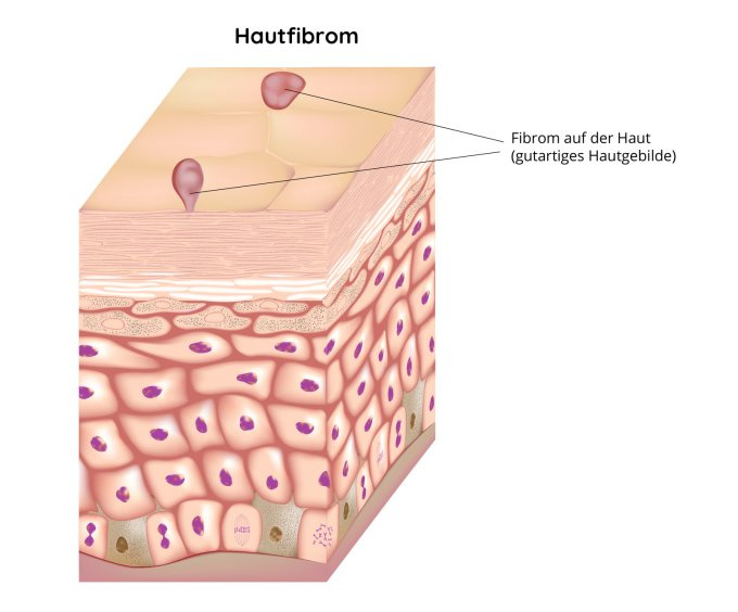 Gutartiges Fibrom auf der Haut