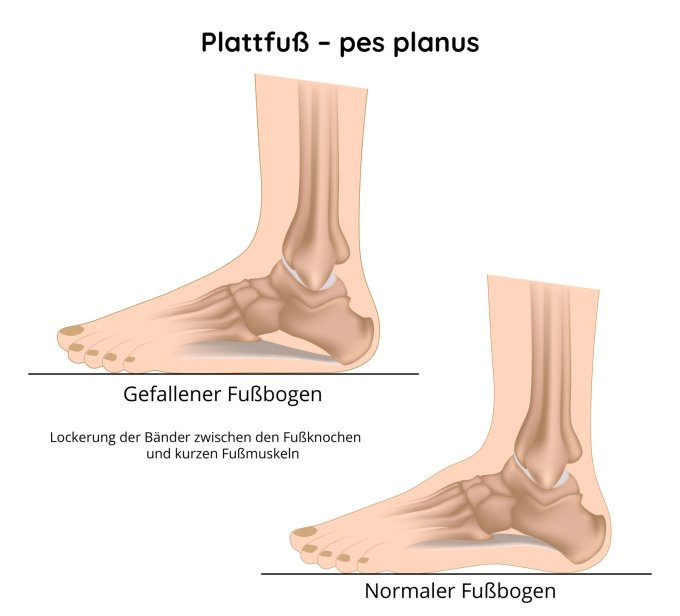 Flacher Fuß - pes Planus