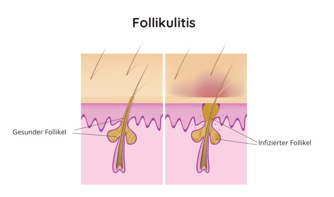Schematische Darstellung der Follikulitis