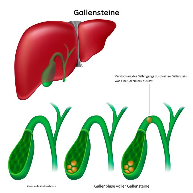 Gallensteine