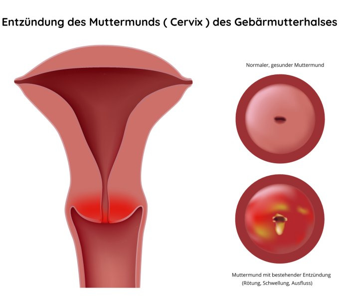 Entzündung des Muttermunds ( Cervix ) des Gebärmutterhalses