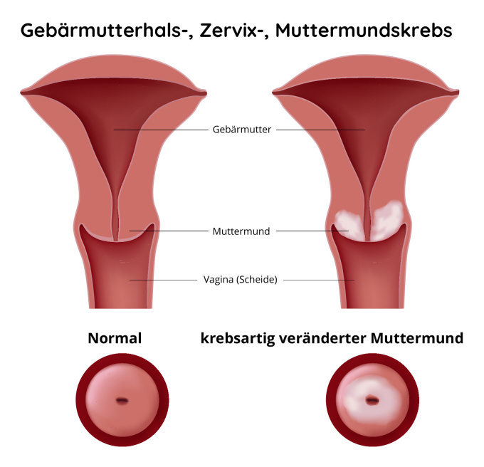 Zervixkarzinom