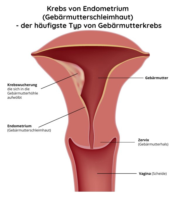 Krebs von Endometrium