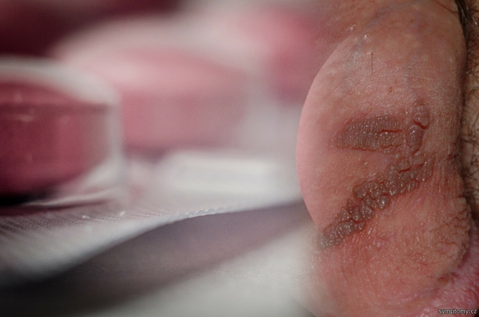 Genitalherpes - Geschlechtskrankheit