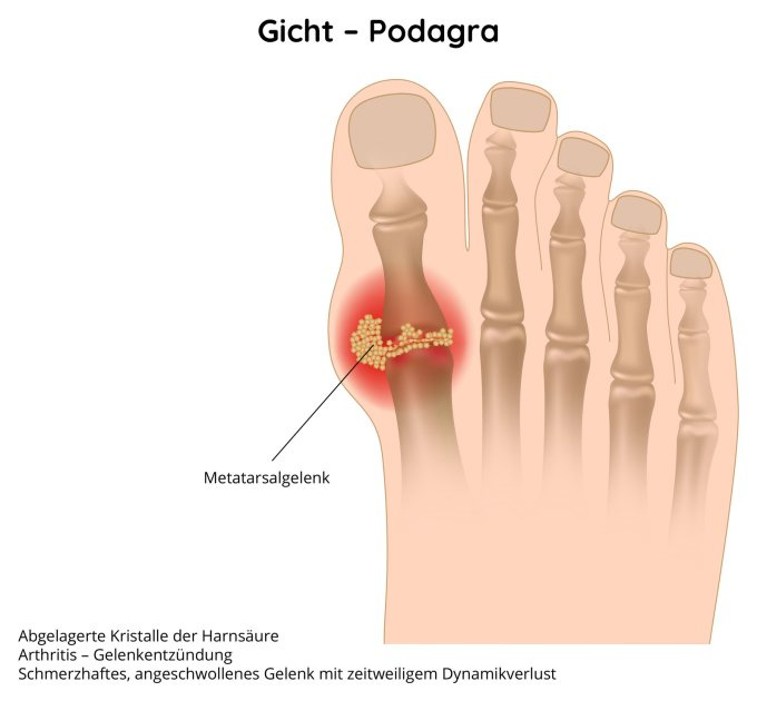Gicht - eine sehr schmerzhafte Krankheit