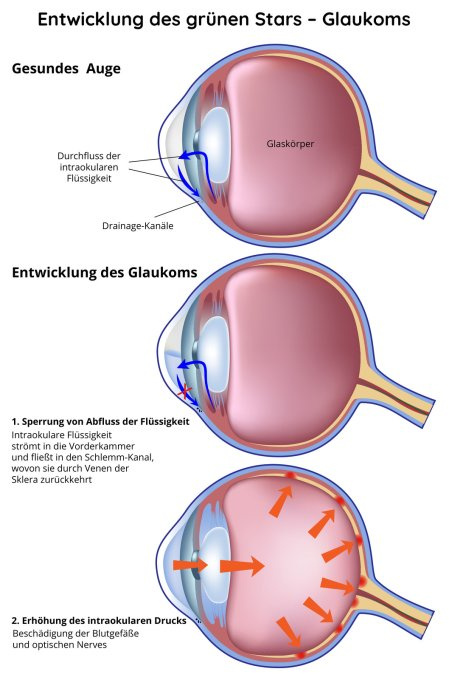 Entwicklung des Glaukoms