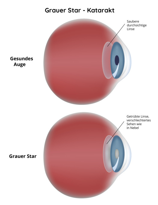 Grauer Star, Katarakt