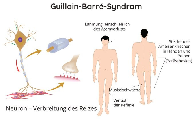 Manifestationen von Guillain-Barré-Syndrom