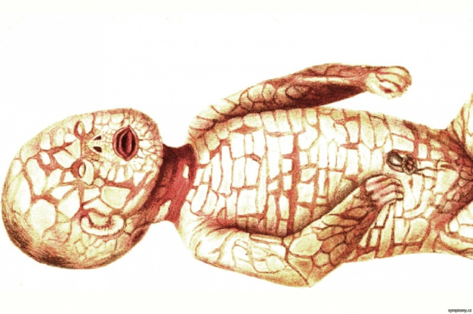 Harlequin ichtyosis