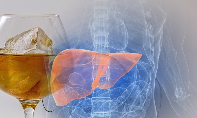Durch übermäßige Alkoholanwendung beschädigte Leber