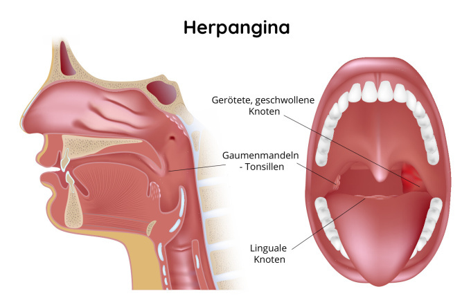 Herpangina - geschwollene Lymphknoten