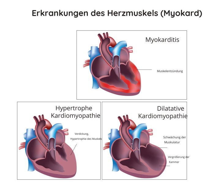 Erkrankungen des Herzmuskels (Myokard)