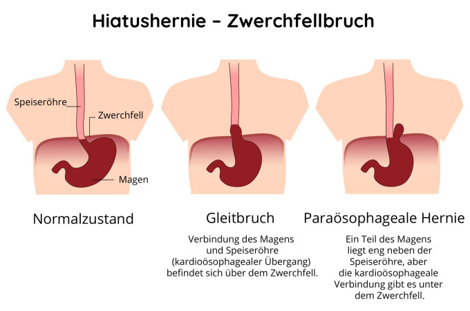 Darstellung des Zwerchfellbruchs