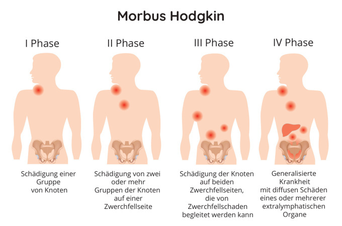 Morbus Hodgkin