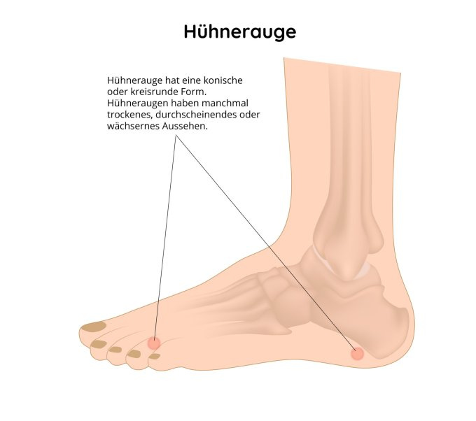 Hühnerauge