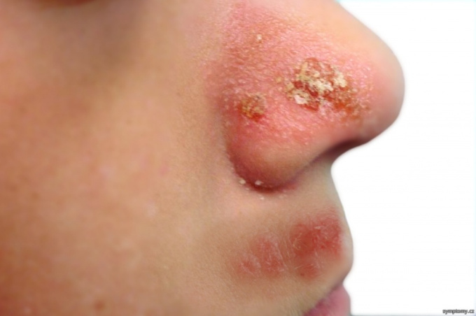 Impetigo auf der Nase