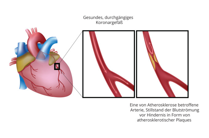 Unterschied zwischen dem gesunden und betroffenen Koronargefäß