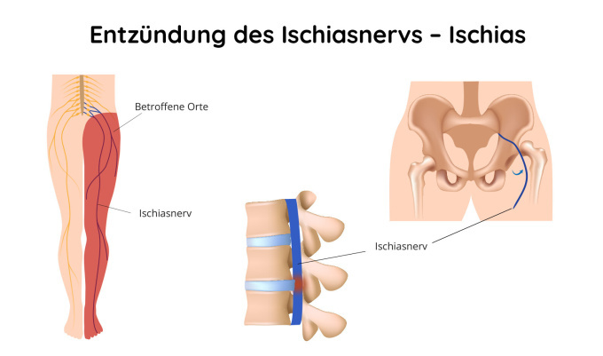 Entzündung des Ischiasnervs - Ischias