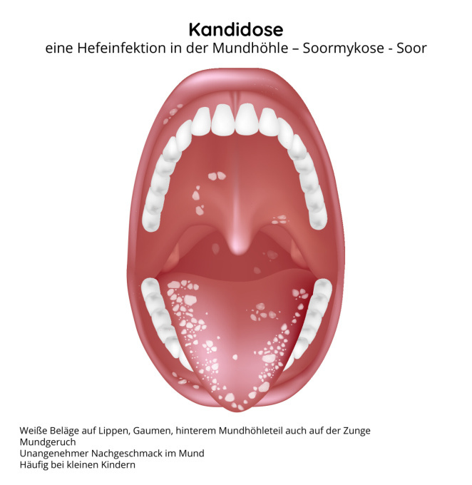 Kandidose in der Mundhöhle