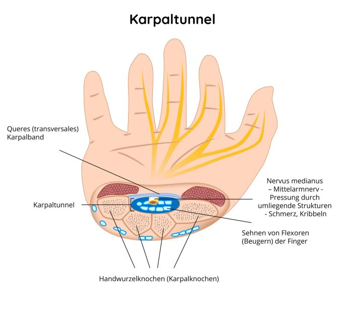 Karpaltunnel