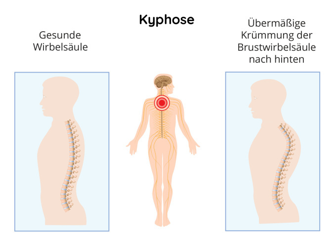 Darstellung der Kyphose