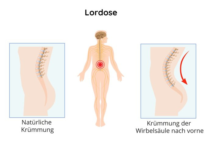 Krümmung der Wirbelsäule bei Lordose