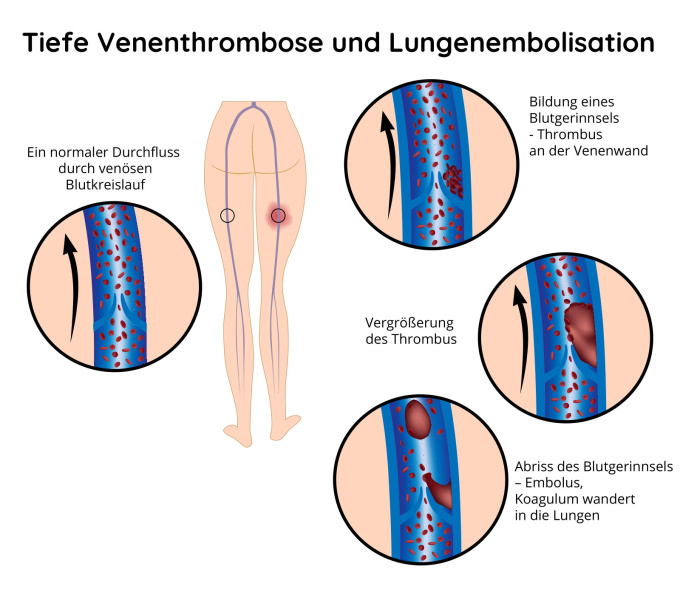 Tiefe Venenthrombose und Lungenembolisation
