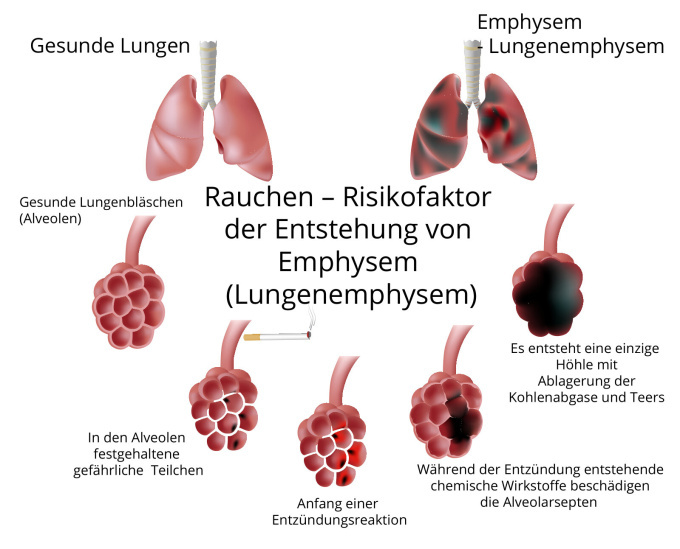 Das Rauchen - Risikofaktor des Lungenemphysems