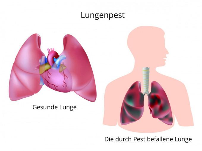 Lungenpest