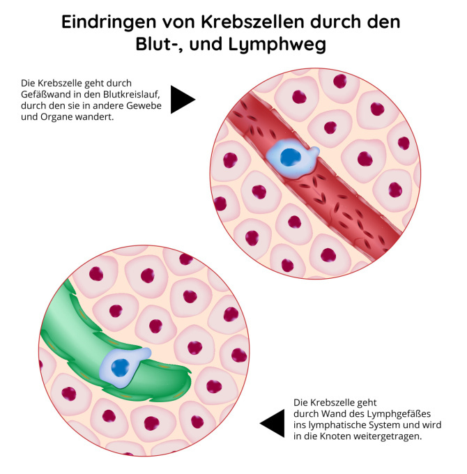 Durchdringung der Krebszellen durch Blut-, und lymphatischen Weg
