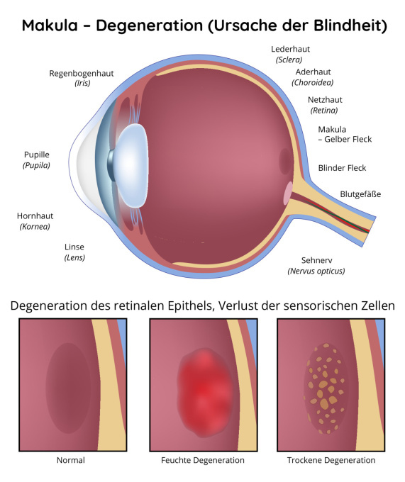 Makuladegeneration - Ursache der Blindheit