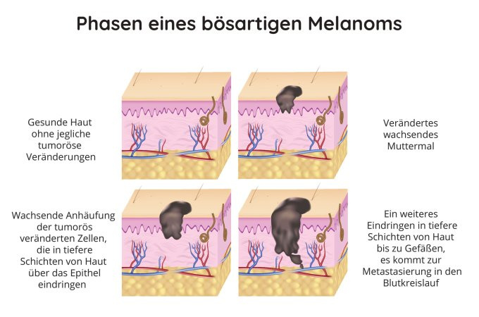 Phasen eines malignen Melanoms