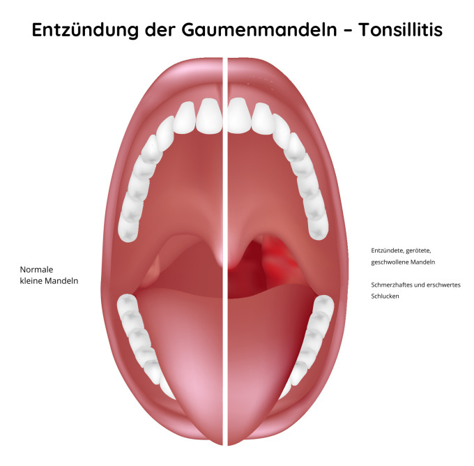Entzündung der Gaumenmandeln – Tonsillitis