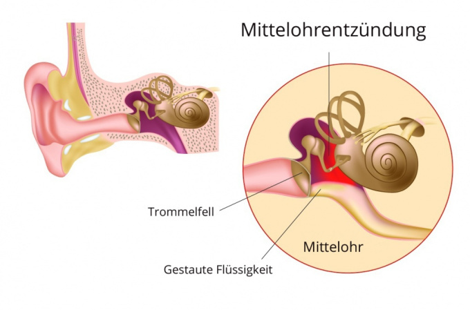 Schematische Darstellung der Mittelohrentzündung