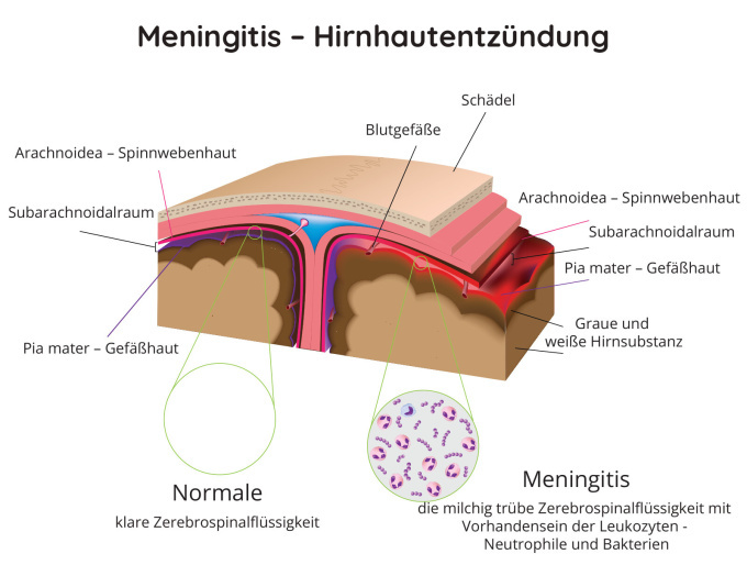 Meningokokkenmeningitis - schematische Darstellung