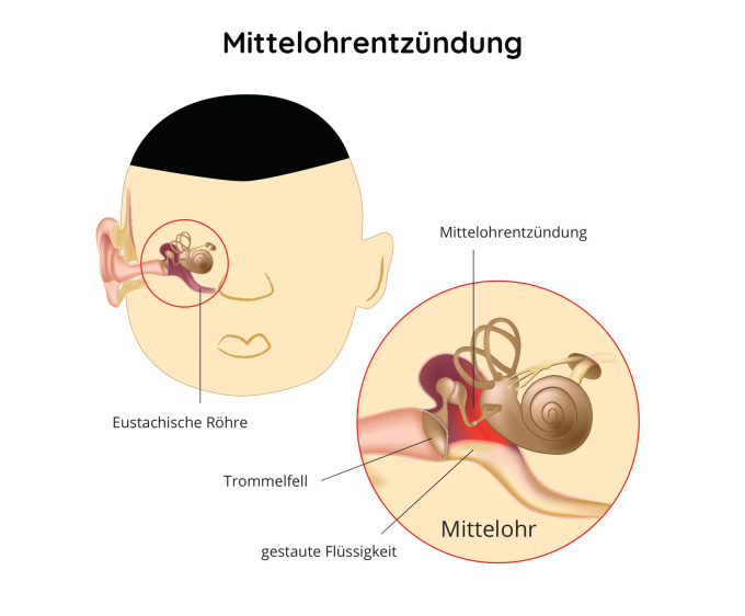Mittelohrentzündung