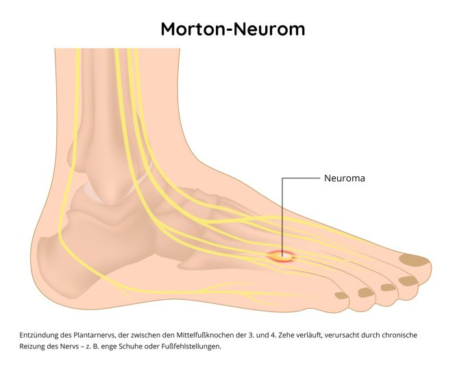 Morton-Neurom