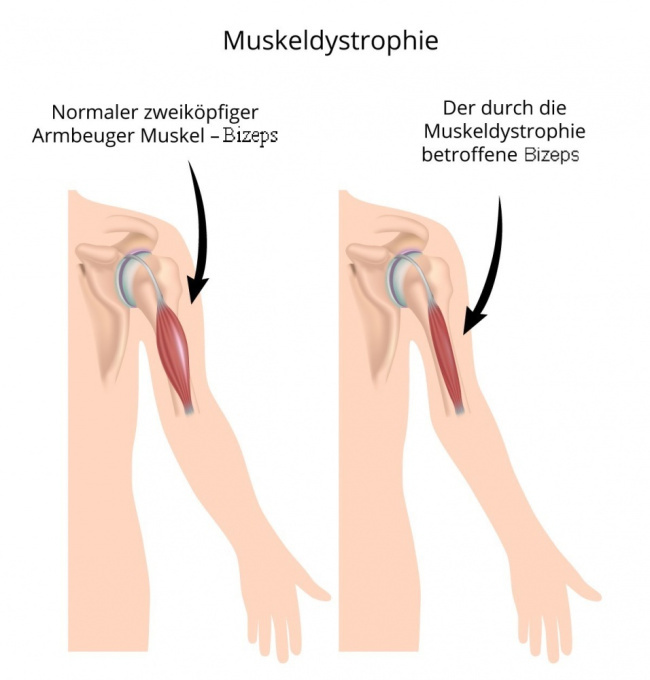 Muskeldystrophie