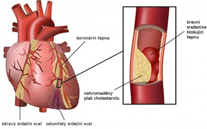 Mit Infarkt betroffenes Herz