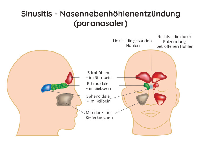 Sinusitis - Nasennebenhöhlenentzündung