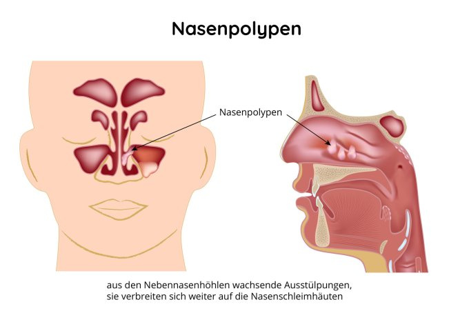 Nasenpolypen