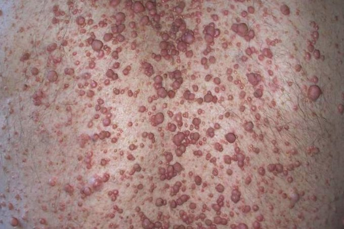 Neurofibromatose
